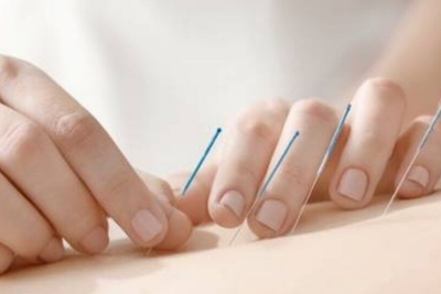 Akupunktura – uspostavite balans vašeg organizma - Popusti