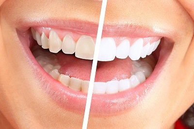  Lasersko izbeljivanje zuba tretman od 3 nanosenja gela