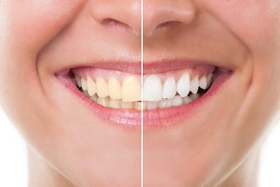 Blistavo beli zubi pomoću tretmana sa Zoom lampom, AKCIJA